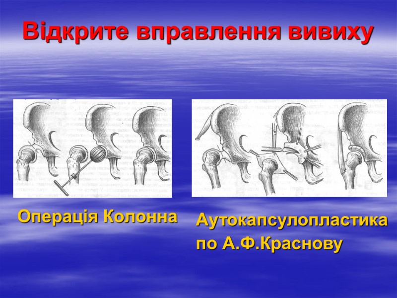 Відкрите вправлення вивиху Операція Колонна Аутокапсулопластика  по А.Ф.Краснову